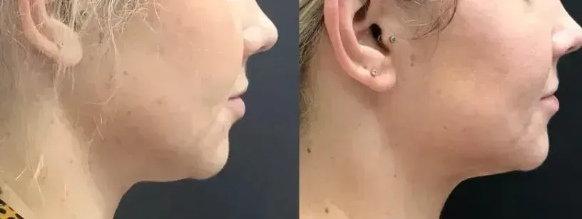 Före och efter HIFU-behandling av dubbelhaka