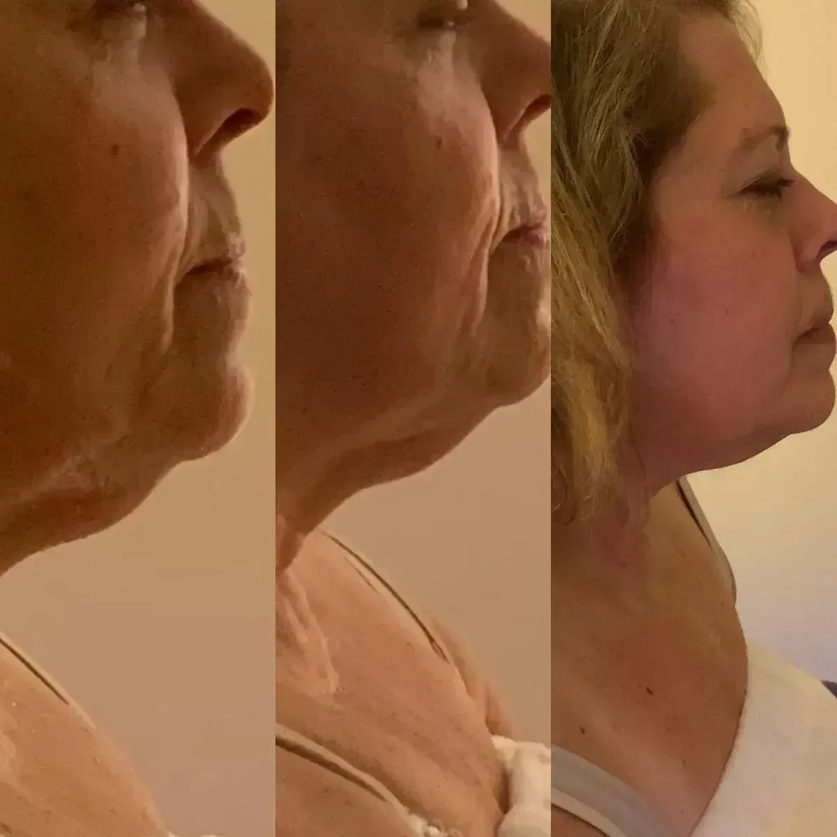 Före och efter HIFU Ultraformer dubbelhaka